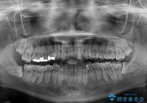 骨格的な問題を側方拡大で解決　ワイヤー矯正治療の治療前