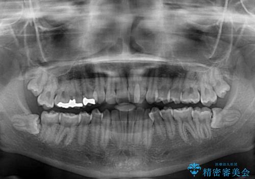 骨格的な問題を側方拡大で解決 ワイヤー矯正治療の治療前