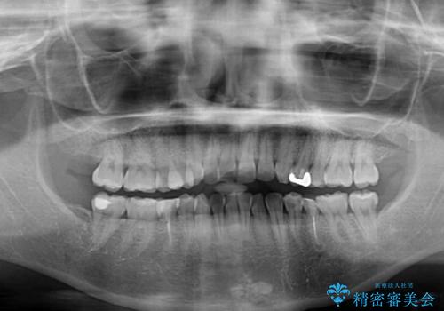 開咬と前方に飛び出した前歯 インビザラインによる矯正治療の治療前