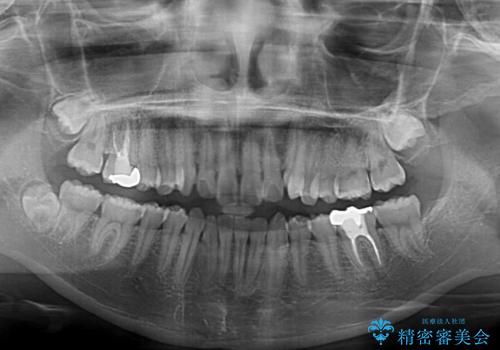 八重歯を確実に改善 補助装置を併用したインビザライン矯正治療の治療前
