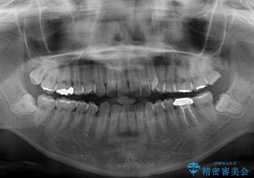 急速拡大装置 狭い上顎骨を拡大してワイヤー装置で八重歯を短期間治療の治療前