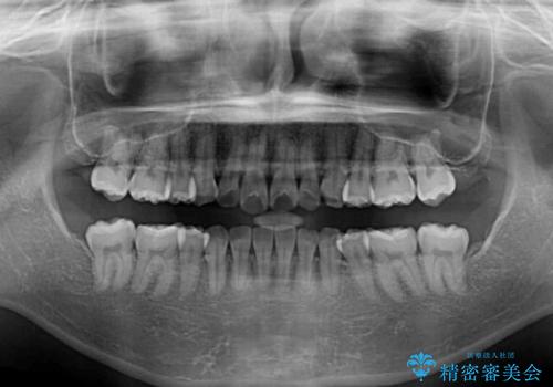 インビザライン・モデレートを用いて気になる前歯を矯正治療の治療前