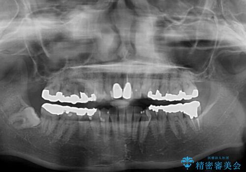 気になる前歯 ワイヤー矯正とセラミック治療の治療前