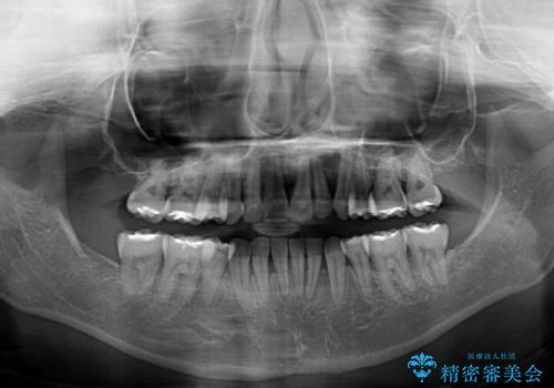 【モニター】顎のゆがみをカムフラージュ　ワイヤー装置の抜歯矯正の治療後