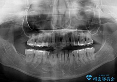 【モニター】顎のゆがみをカムフラージュ ワイヤー装置の抜歯矯正の治療後