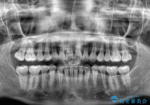 【モニター】上顎前突と奥歯の鋏状咬合　補助装置を用いたインビザライン矯正治療の治療後