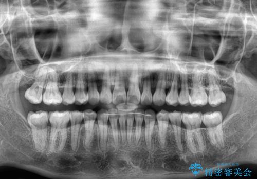 【モニター】上顎前突と奥歯の鋏状咬合 補助装置を用いたインビザライン矯正治療の治療後