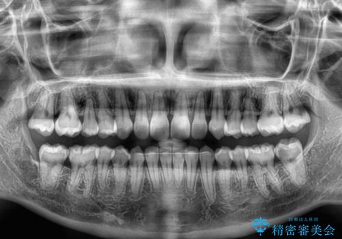 埋もれた奥歯をワイヤーで改善　インビザラインによる矯正治療の治療後