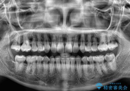 埋もれた奥歯をワイヤーで改善 インビザラインによる矯正治療の治療後