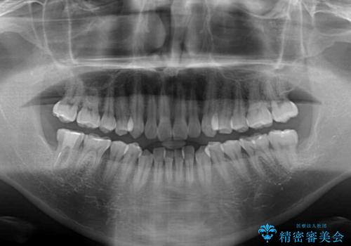 目立たない装置でデコボコを改善　ハーフリンガルによる矯正治療の治療前