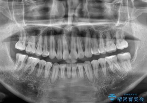 目立たない装置でデコボコを改善　ハーフリンガルによる矯正治療の治療後