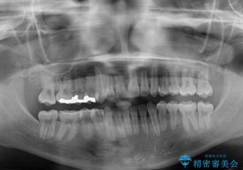 骨格的な問題を側方拡大で解決 ワイヤー矯正治療の治療後