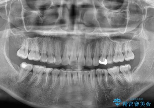 開咬と前方に飛び出した前歯 インビザラインによる矯正治療の治療後