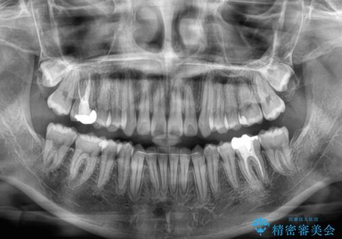 八重歯を確実に改善　補助装置を併用したインビザライン矯正治療の治療後