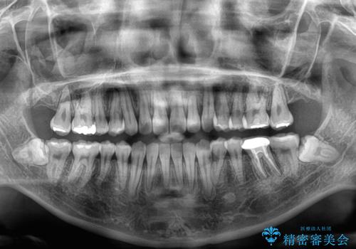 急速拡大装置　狭い上顎骨を拡大してワイヤー装置で八重歯を短期間治療の治療後