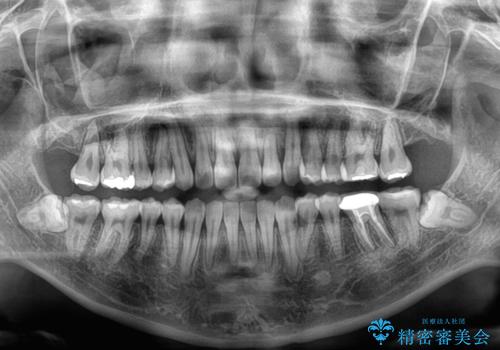 急速拡大装置 狭い上顎骨を拡大してワイヤー装置で八重歯を短期間治療の治療後