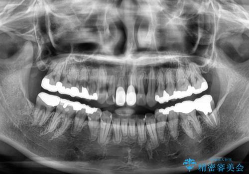 気になる前歯 ワイヤー矯正とセラミック治療の治療後