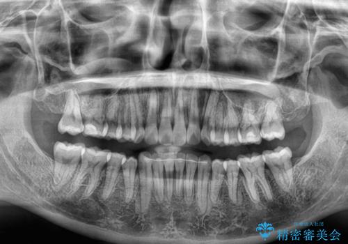 前歯のデコボコを解消 インビザラインの矯正治療の治療後