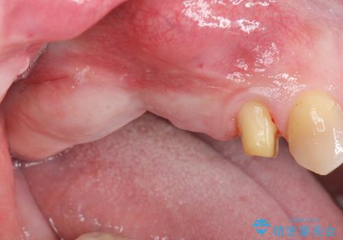 骨の造成を伴う奥歯のインプラント治療の症例 治療前