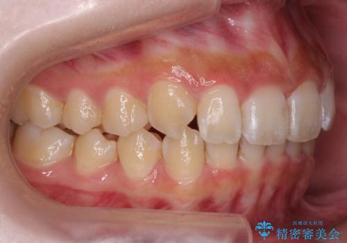 前歯の並び インビザライン 非抜歯で 深いかみ合わせの治療の治療後