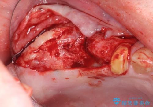骨の造成を伴う奥歯のインプラント治療の治療中
