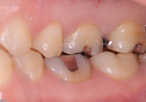 【セラミッククラウン】歯を白くしたいの治療前