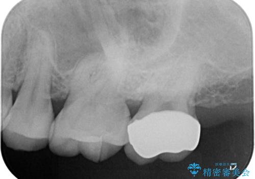 【セラミッククラウン】インレーの下の大きな虫歯の治療後