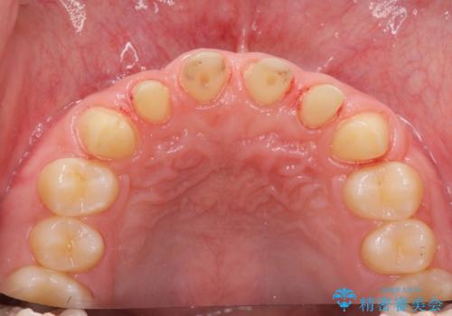 歯周外科を行い、歯ぐきの状態を整えた前歯セラミック治療の治療中
