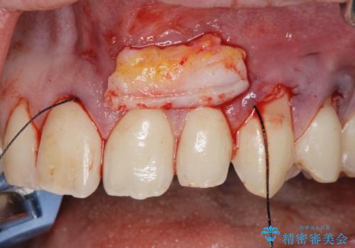 [ 根面被覆 ]  歯ぐきのさがりを改善、結合組織移植術の治療中