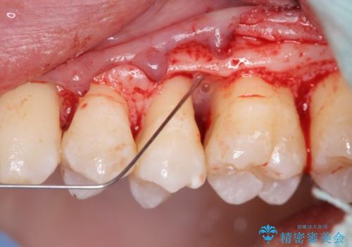 [ 歯周病 ]  歯槽骨の再生治療で歯を残すの治療中