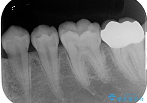 左奥歯が痛い。(親知らず抜歯 ジルコニアクラウン)の治療後