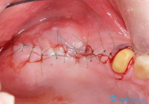 骨の造成を伴う奥歯のインプラント治療の治療中