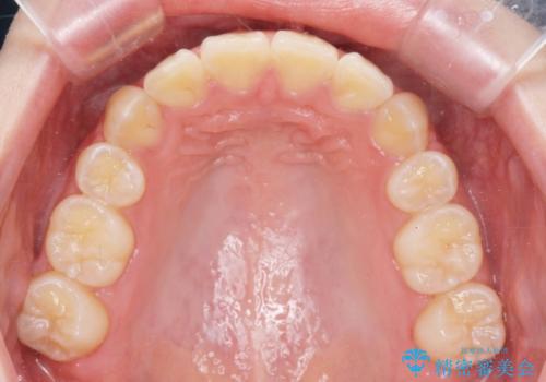 [ 八重歯を治す ]   小臼歯4本抜歯 マルチブラケット矯正の治療後