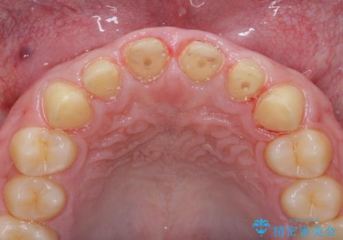 歯周外科を行い、歯ぐきの状態を整えた前歯セラミック治療の治療中