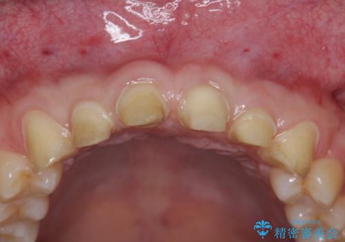 歯周外科を行い、歯ぐきの状態を整えた前歯セラミック治療の治療後