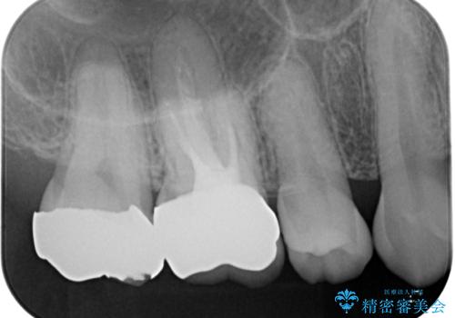 金属の詰め物が取れた。セラミックを入れたい!　オールセラミッククラウンの治療後