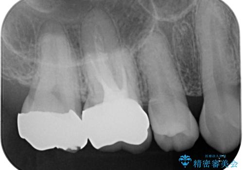 金属の詰め物が取れた。セラミックを入れたい! オールセラミッククラウンの治療後