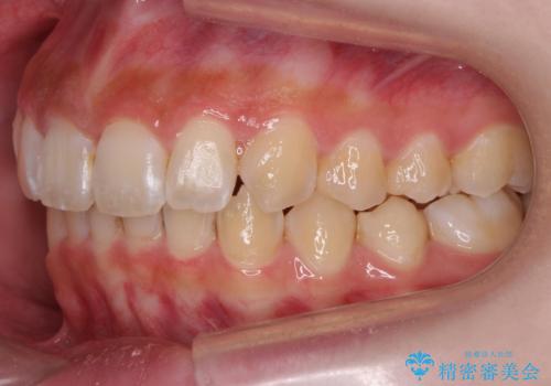 前歯の並び インビザライン 非抜歯で 深いかみ合わせの治療の治療後