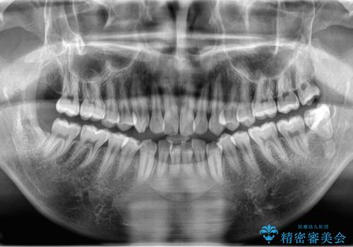 親知らず、過剰歯抜歯の抜歯の症例 治療後
