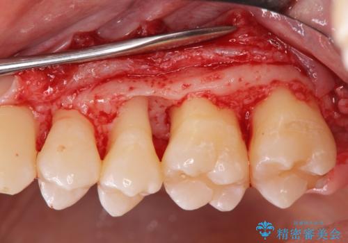 [ 歯周病 ]  歯槽骨の再生治療で歯を残すの治療中