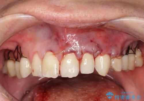 [ 根面被覆 ]  歯ぐきのさがりを改善、結合組織移植術の治療中