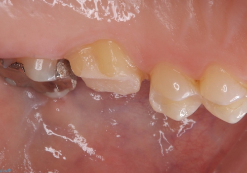 【セラミッククラウン】歯を白くしたいの治療中