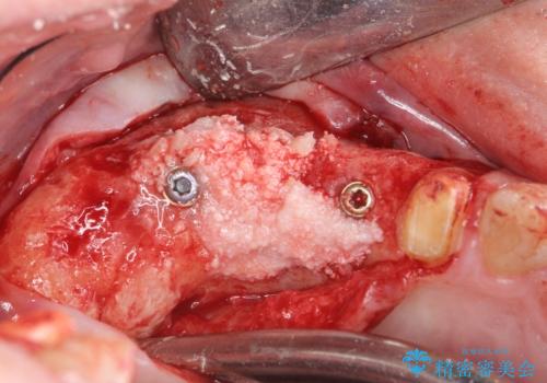 骨の造成を伴う奥歯のインプラント治療の治療中