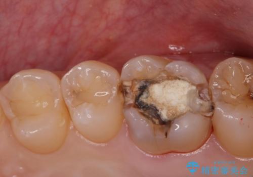 金の詰め物の中にある虫歯を除去してセラミック治療の治療中