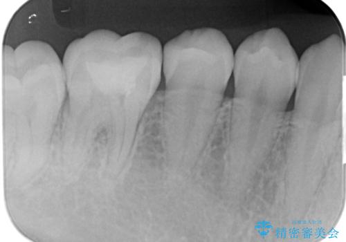 古い樹脂を除去してe-maxインレーの治療後