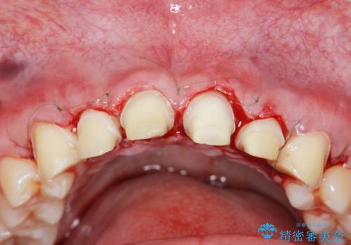 歯周外科を行い、歯ぐきの状態を整えた前歯セラミック治療の治療中