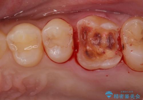 金の詰め物の中にある虫歯を除去してセラミック治療の治療中
