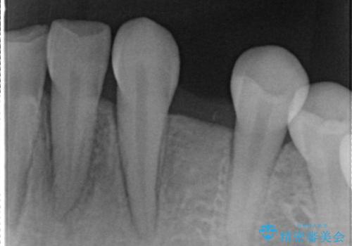 欠損歯をブリッジにて補綴の治療前