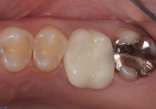 【セラミッククラウン】歯を白くしたいの治療後