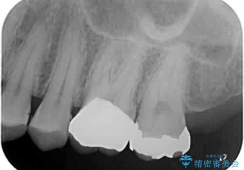 【セラミッククラウン】歯を白くしたいの治療後